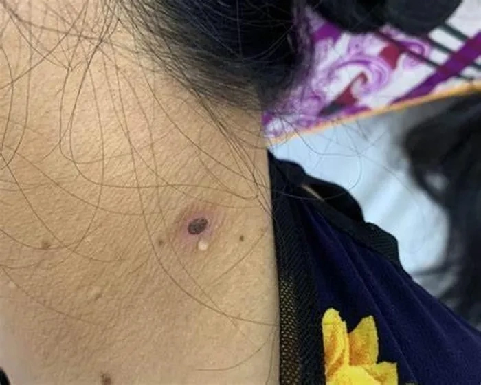 Liên tiếp các ca bệnh nhập viện do sốt mò, cần làm gì để phòng bệnh?