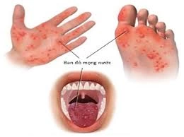 Số trẻ mắc tay chân miệng tại Hà Nội tiếp tục tăng