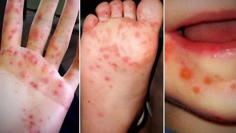 Chủ động ngăn ngừa bệnh tay – chân – miệng ở trẻ