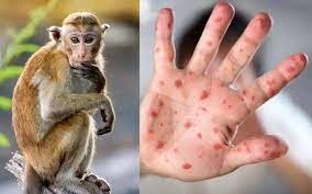 Bộ Y tế cảnh báo mầm bệnh đậu mùa khỉ trong cộng đồng