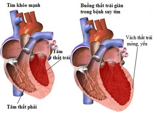 Nhồi máu cơ tim – các dấu hiệu cảnh báo sớm và cách xử trí để hạn chế tử vong