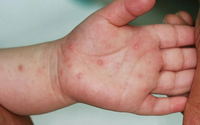 Tay chân miệng ở Hà Nội tăng gấp 5 lần cùng kỳ, dự báo tiếp tục “nóng”