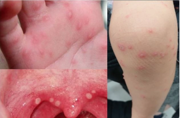 Món ăn bài thuốc hỗ trợ điều trị bệnh tay chân miệng