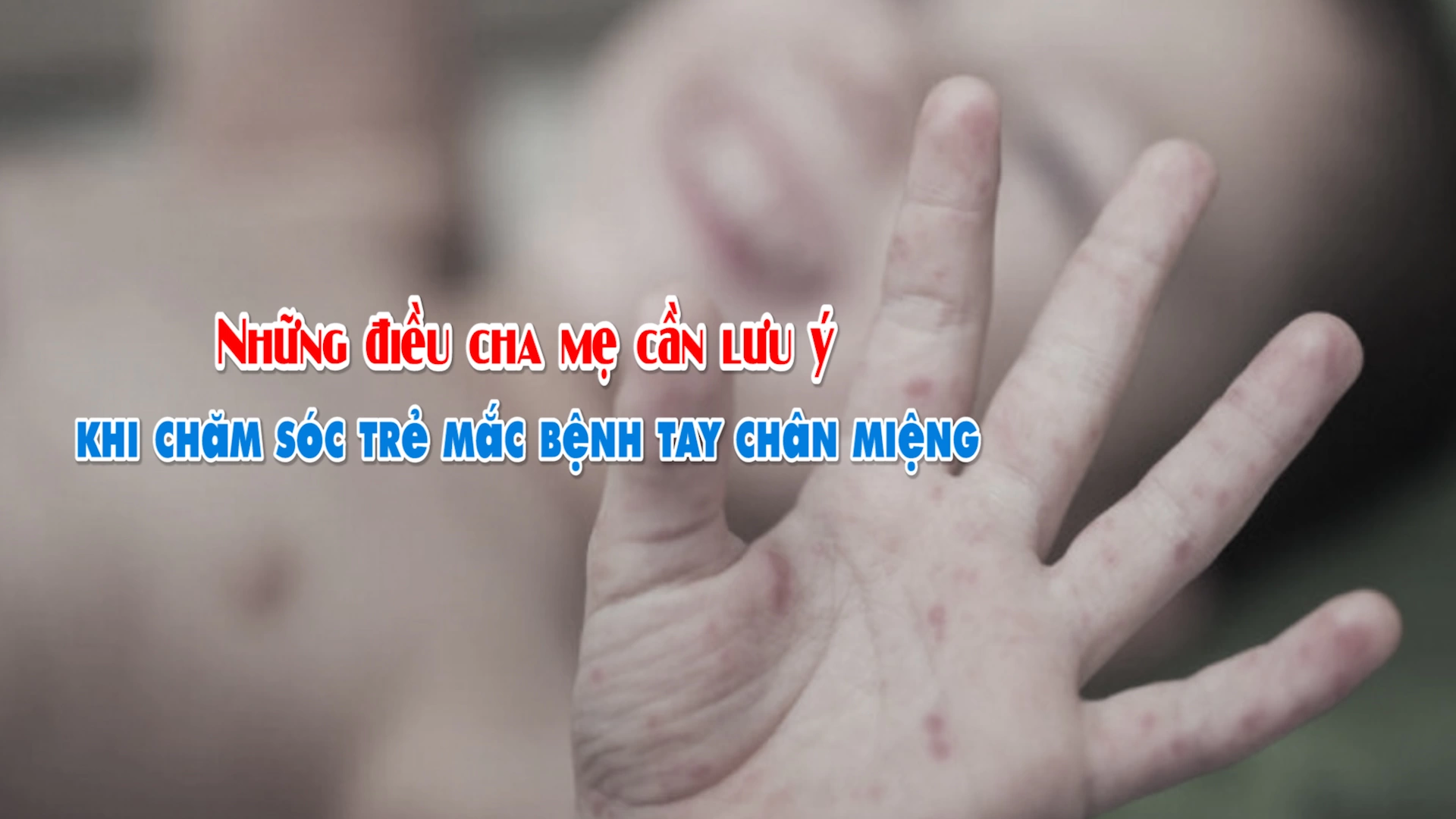 Những điều cha mẹ cần lưu ý khi chăm sóc trẻ mắc bệnh tay chân miệng